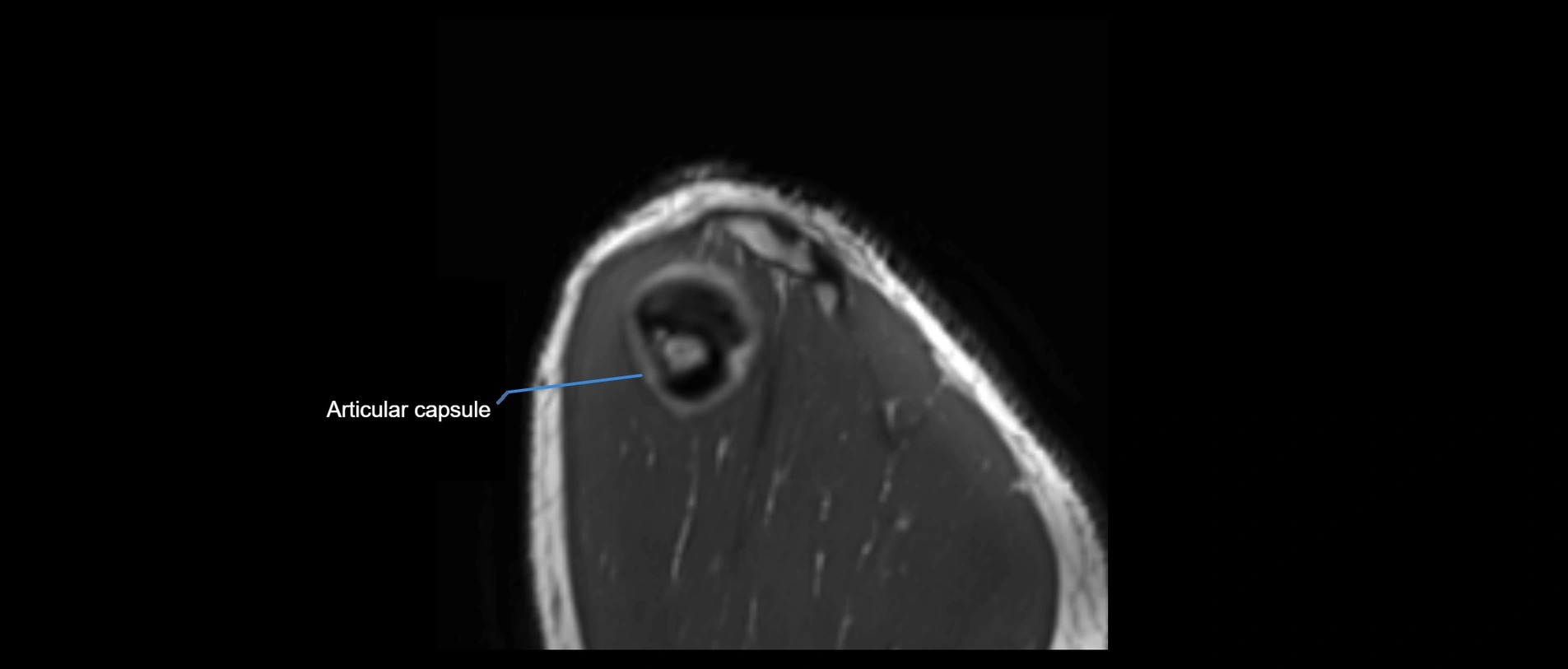 shoulder ligaments sagittal  cross sectional anatomy 3T MRI AI enhanced radiology image -img-00001-00056.webp